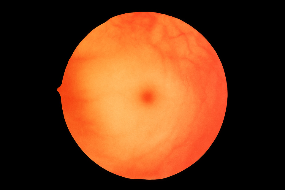 Judeus: Doenças oculares especificas