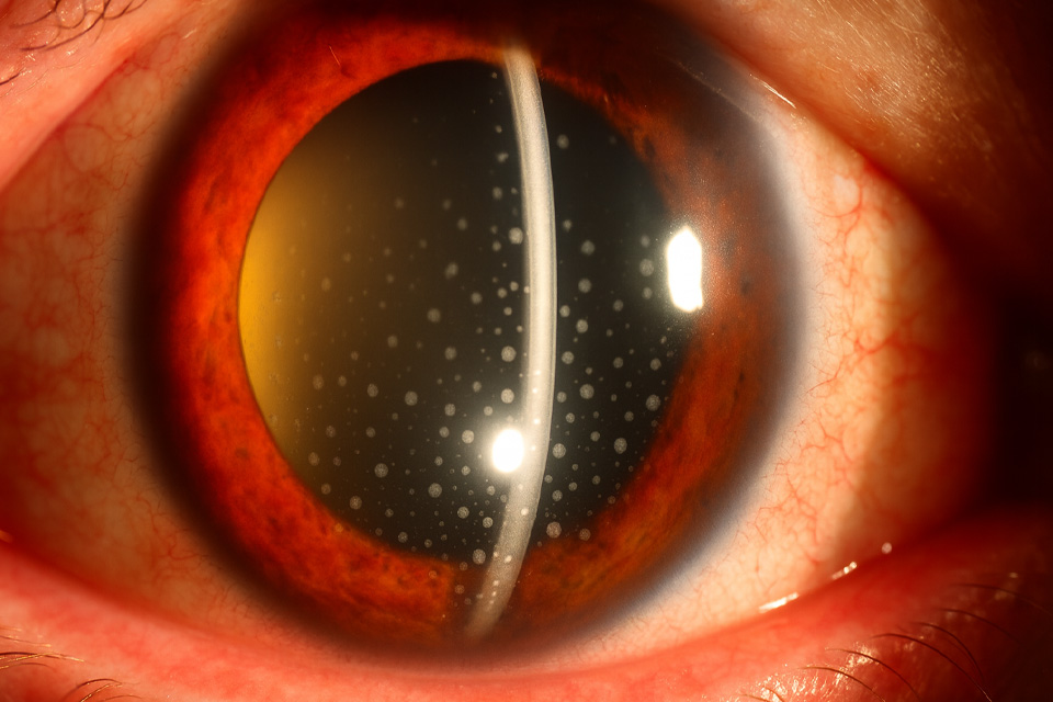 Uveite: O olho vermelho pode ser grave